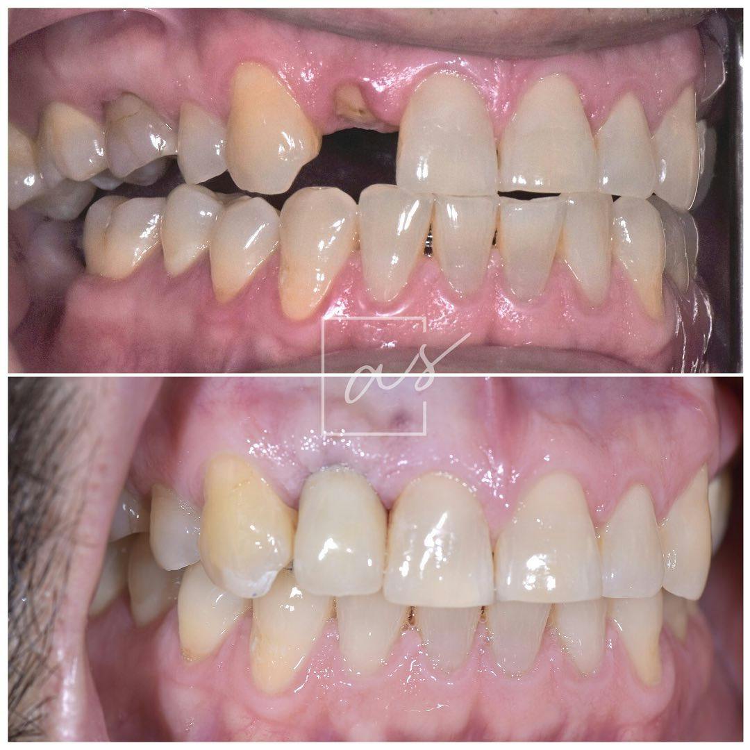 Dental Implants Before & After Gallery - Patient 254037 - Image 2