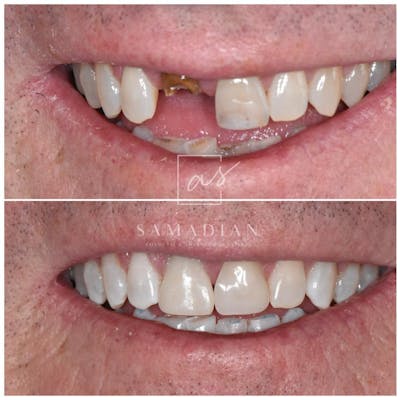Dental Implants Before & After Gallery - Patient 221697 - Image 1