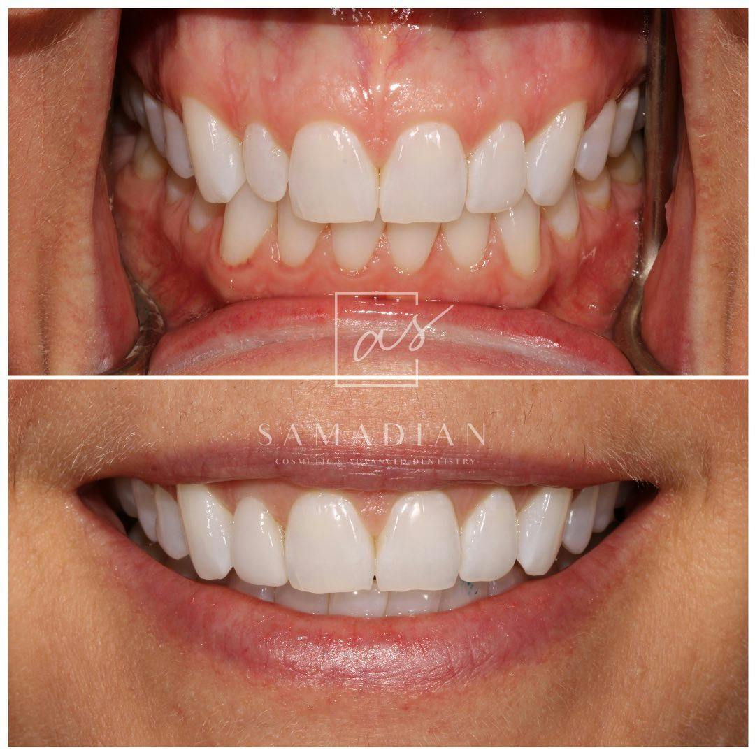 Veneers Before & After Gallery - Patient 641737 - Image 2