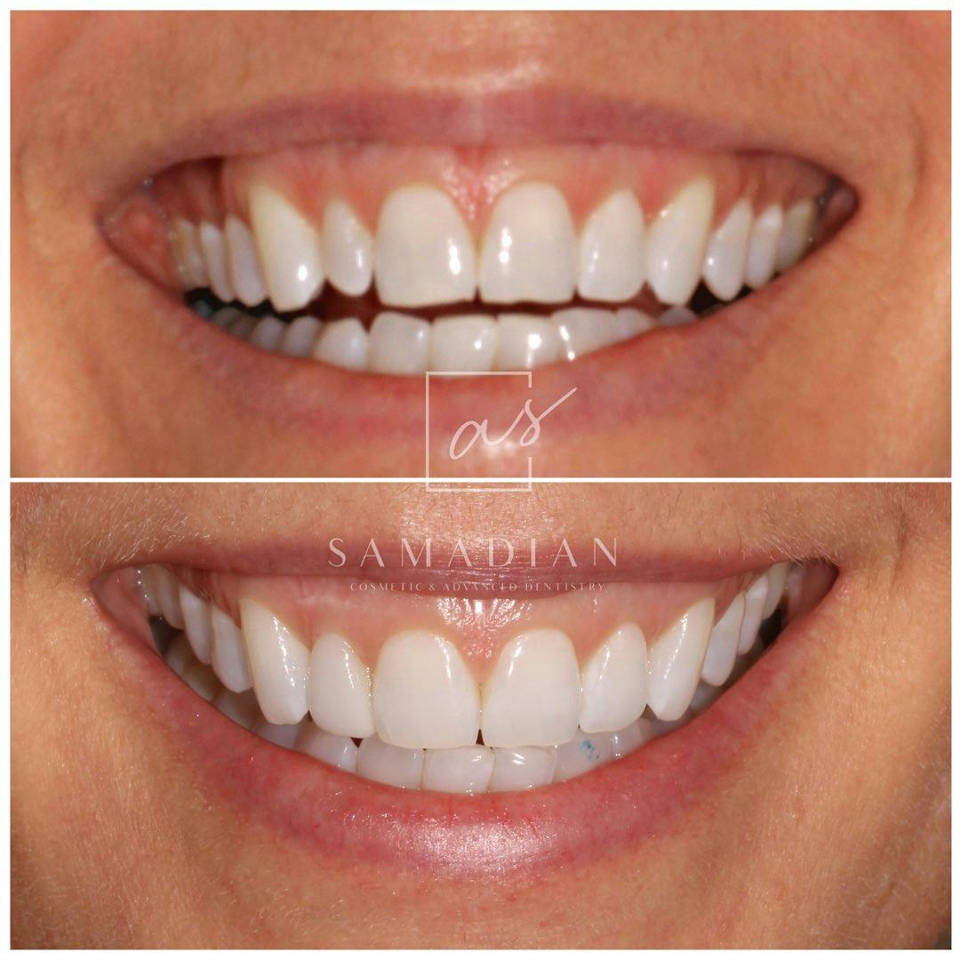 Veneers Before & After Gallery - Patient 641737 - Image 1