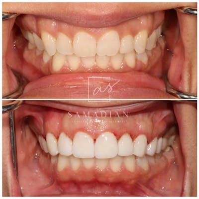 Veneers Before & After Gallery - Patient 433928 - Image 1