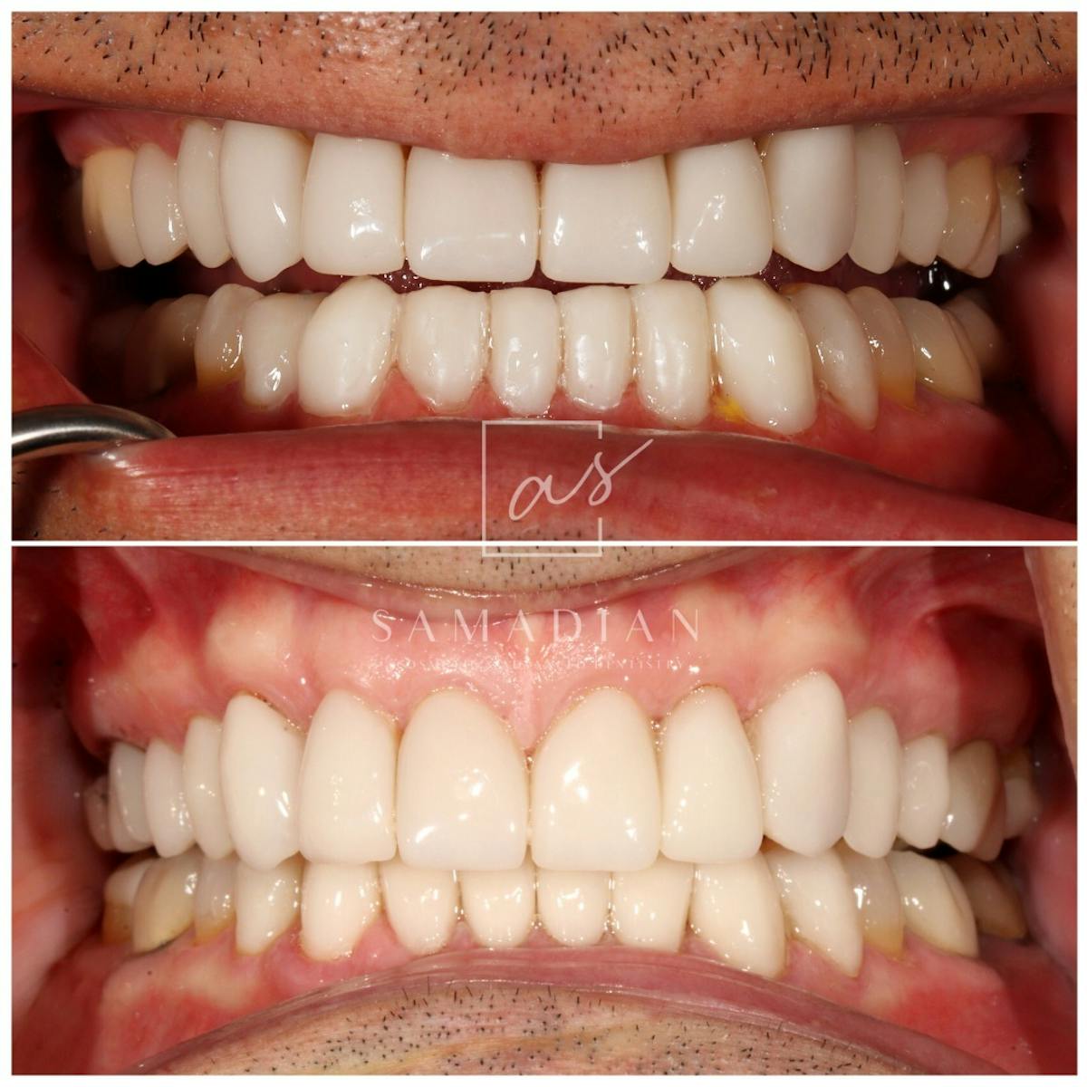 Veneers Before & After Gallery - Patient 902692 - Image 1