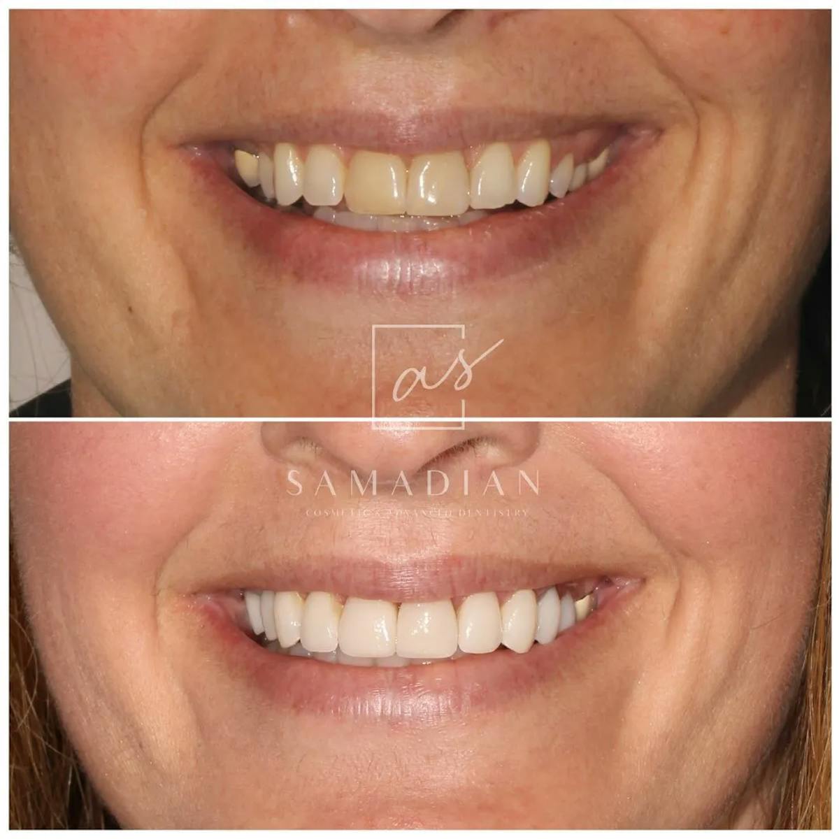 Veneers Before & After Gallery - Patient 236169 - Image 1
