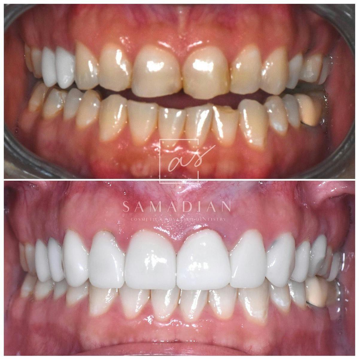 Veneers Before & After Gallery - Patient 272515 - Image 1