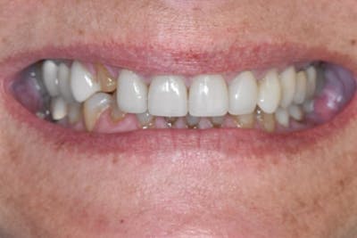 Veneers Before & After Gallery - Patient 284496 - Image 1
