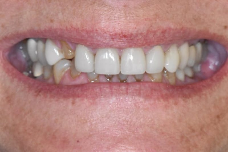 Veneers Before & After Gallery - Patient 284496 - Image 1