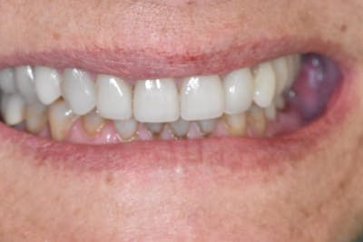 Veneers Before & After Gallery - Patient 284496 - Image 2