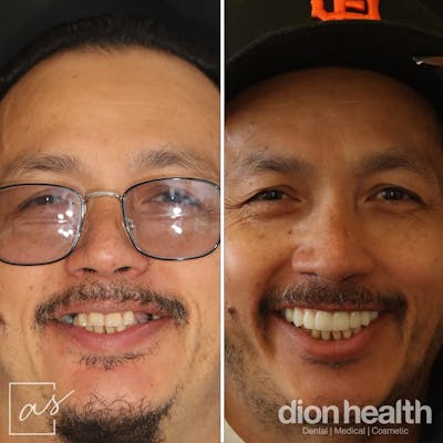 Anti Aging Before & After Gallery - Patient 166968 - Image 1