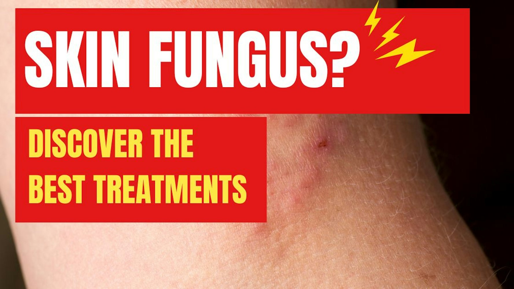 Cover Image for Effective Treatments for Skin Fungus: NanoDefense Pro and More