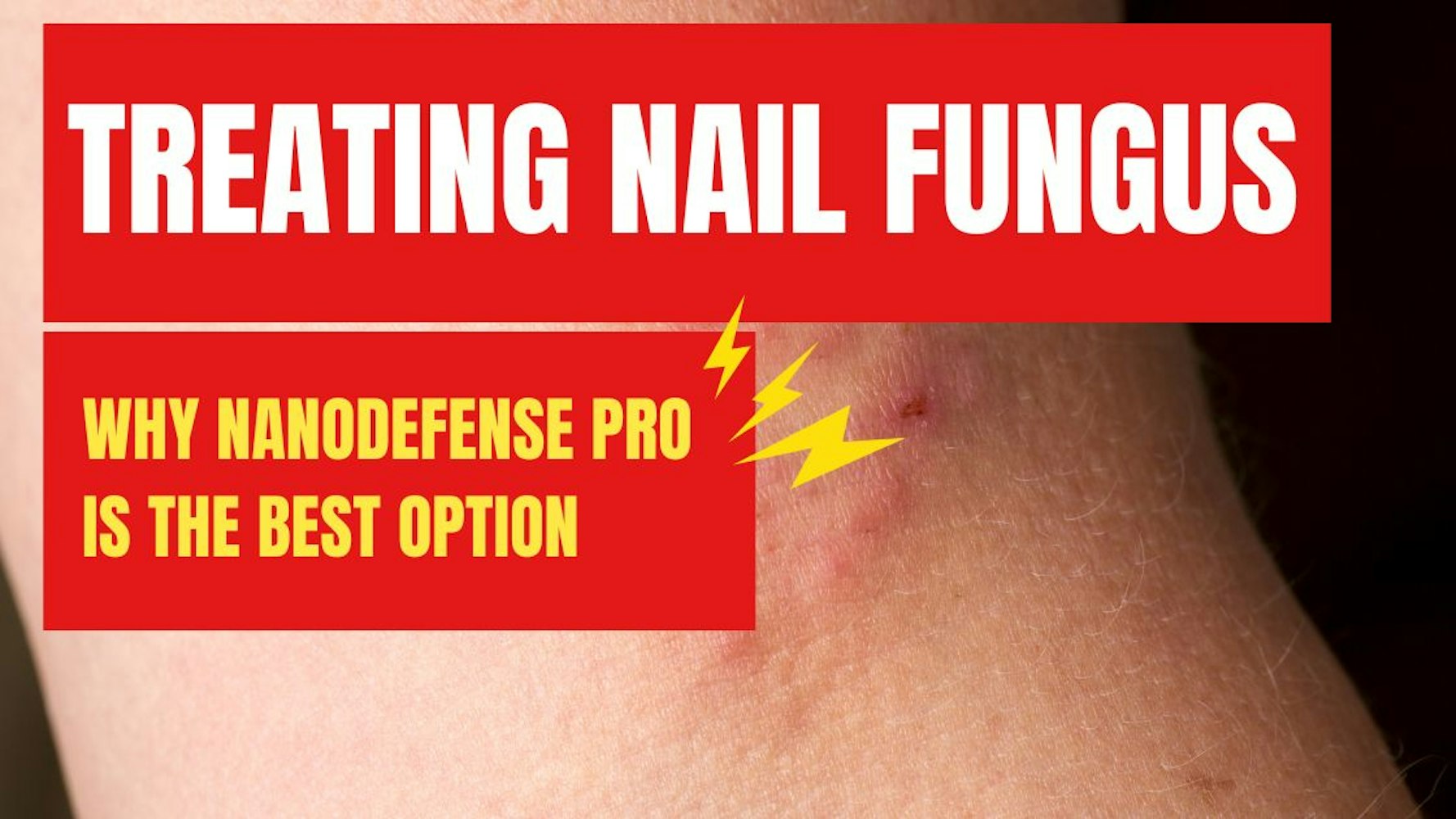 Cover Image for Home Remedies for Treating Nail Fungus: Why NanoDefense Pro is the Best Option
