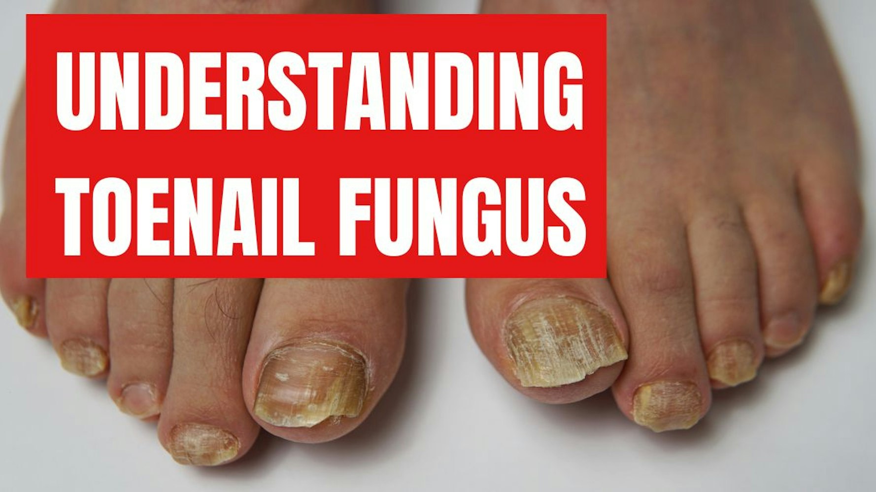 Cover Image for Understanding Toenail Fungus and the Best Treatment Options