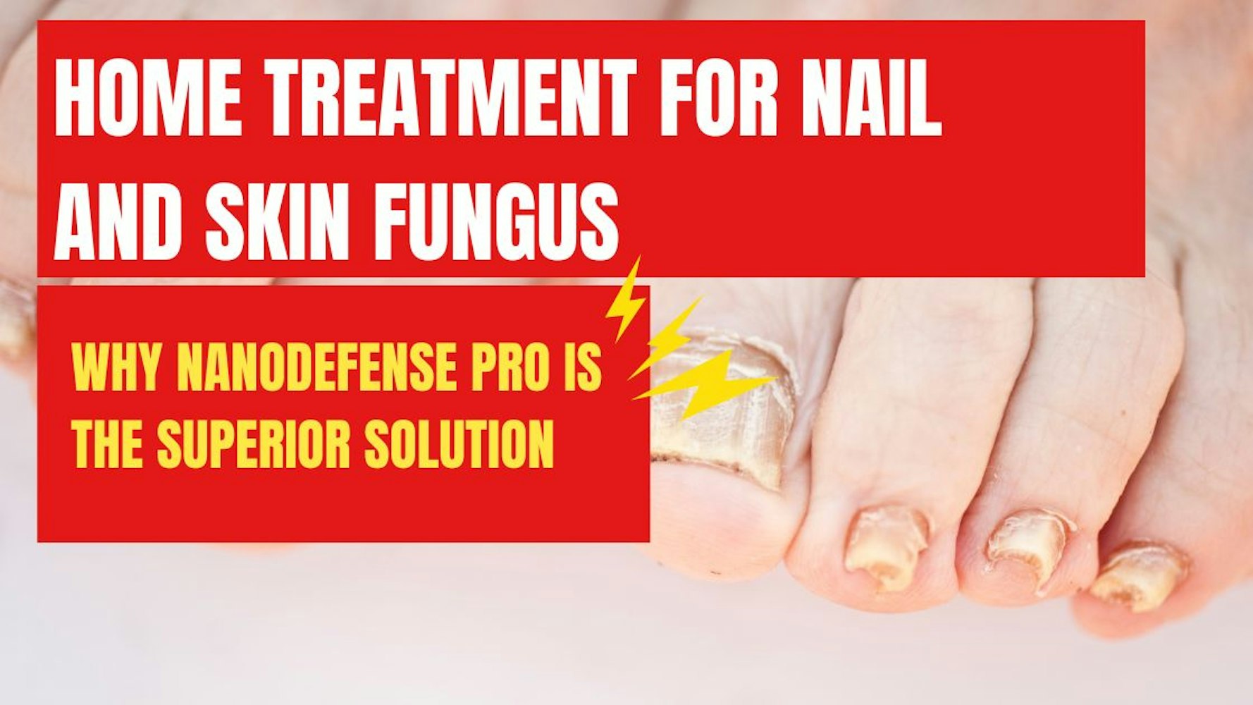 Cover Image for Home Treatment for Nail and Skin Fungus: Why NanoDefense Pro is the Superior Solution