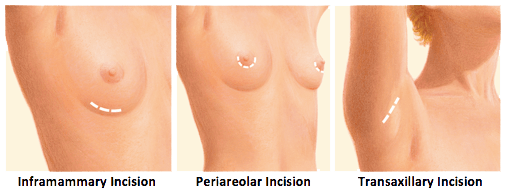 breast augmentation incision infographic
