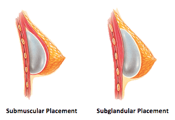 implant placement infographic