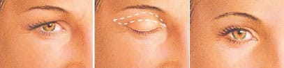 eyelid surgery infographic