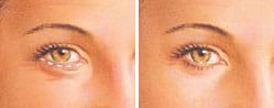 eyelid surgery infographic