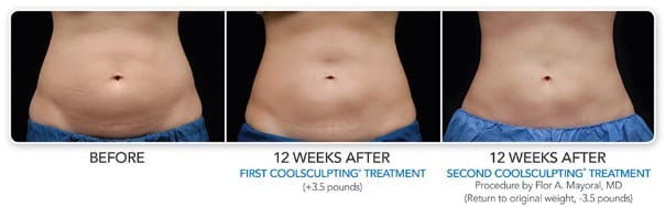 coolsculpting results