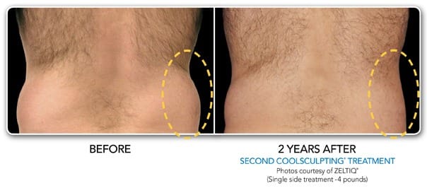 coolsculpting results