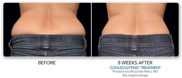 coolsculpting results