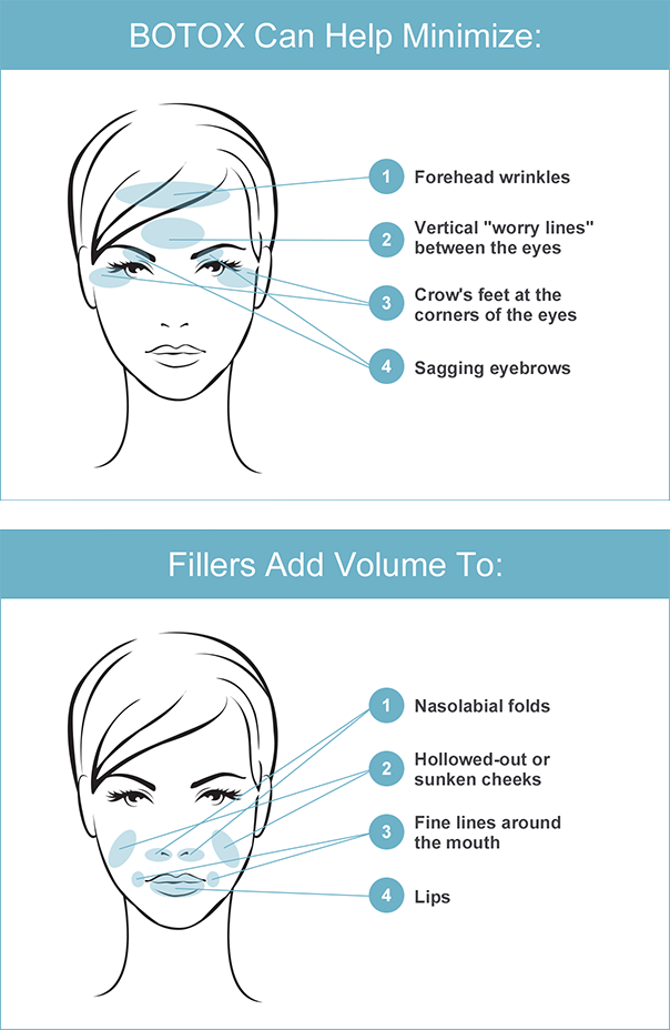 botox infographic