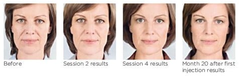 sculptra results