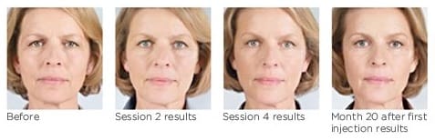 sculptra results