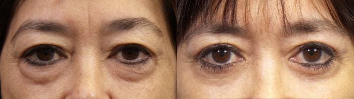 Eyelid Surgery (Blepharoplasty) Before & After Gallery - Patient 193525 - Image 2