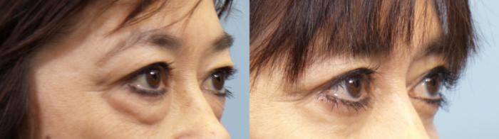Eyelid Surgery (Blepharoplasty) Before & After Gallery - Patient 193525 - Image 1