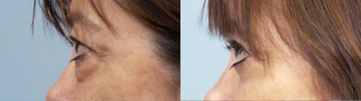Eyelid Surgery (Blepharoplasty) Before & After Gallery - Patient 193525 - Image 3