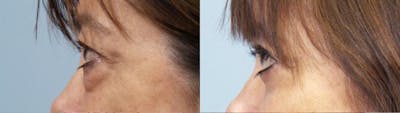 Eyelid Surgery (Blepharoplasty) Before & After Gallery - Patient 193525 - Image 3