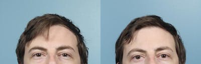 Eyelid Surgery (Blepharoplasty) Before & After Gallery - Patient 215346 - Image 2