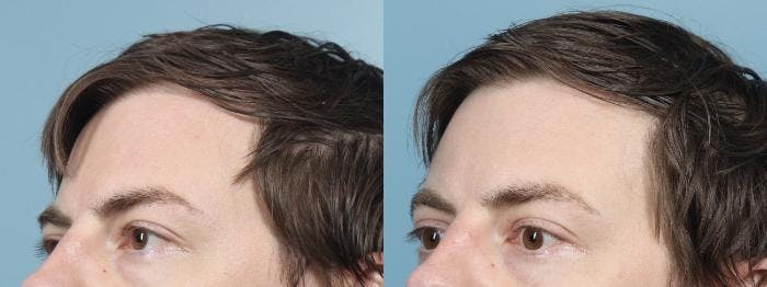 Eyelid Surgery (Blepharoplasty) Before & After Gallery - Patient 215346 - Image 1