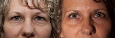 Eyelid Surgery (Blepharoplasty) Before & After Gallery - Patient 131798 - Image 2