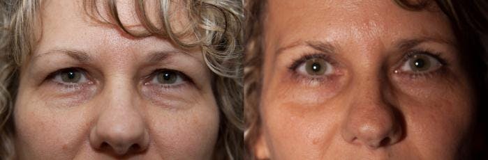 Eyelid Surgery (Blepharoplasty) Before & After Gallery - Patient 131798 - Image 2