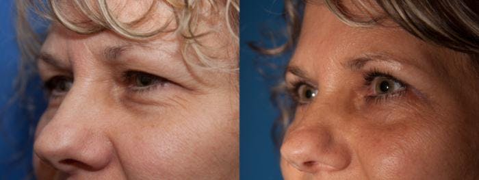 Eyelid Surgery (Blepharoplasty) Before & After Gallery - Patient 131798 - Image 1