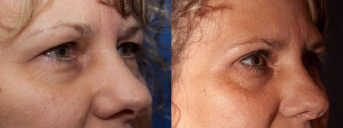 Eyelid Surgery (Blepharoplasty) Before & After Gallery - Patient 131798 - Image 3
