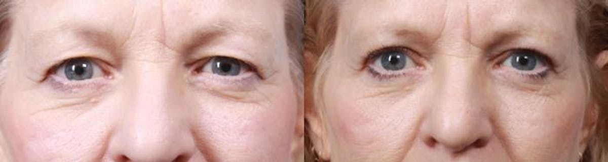 Eyelid Surgery (Blepharoplasty) Before & After Gallery - Patient 375690 - Image 2