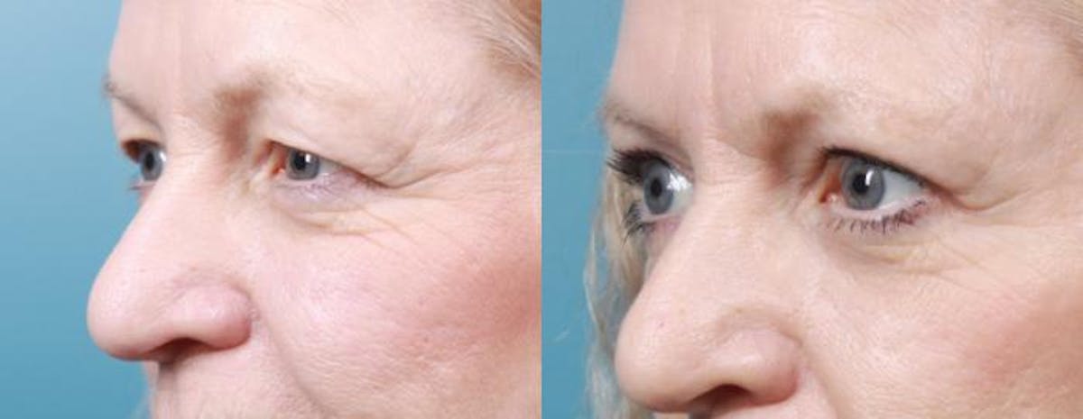 Eyelid Surgery (Blepharoplasty) Before & After Gallery - Patient 375690 - Image 1