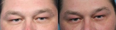 Eyelid Surgery (Blepharoplasty) Before & After Gallery - Patient 814711 - Image 2
