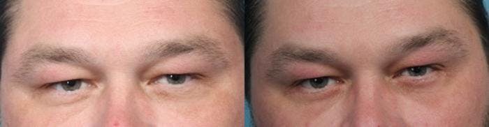 Eyelid Surgery (Blepharoplasty) Before & After Gallery - Patient 814711 - Image 2