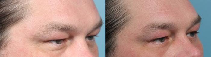 Eyelid Surgery (Blepharoplasty) Before & After Gallery - Patient 814711 - Image 1