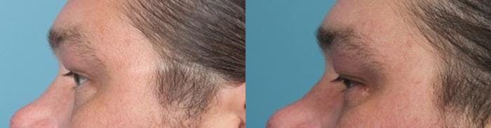 Eyelid Surgery (Blepharoplasty) Before & After Gallery - Patient 814711 - Image 3