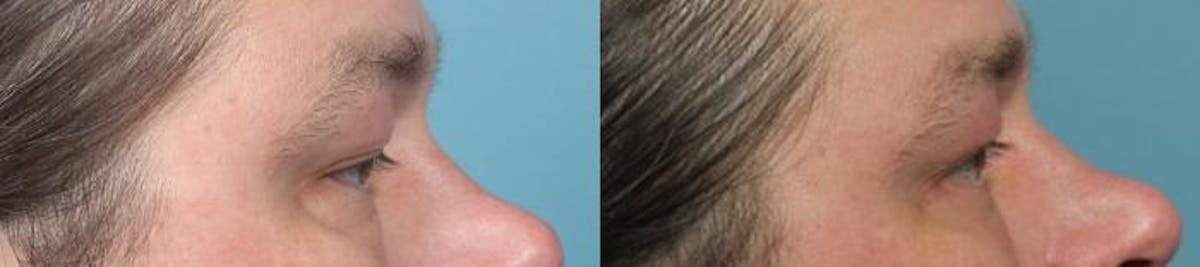 Eyelid Surgery (Blepharoplasty) Before & After Gallery - Patient 814711 - Image 4