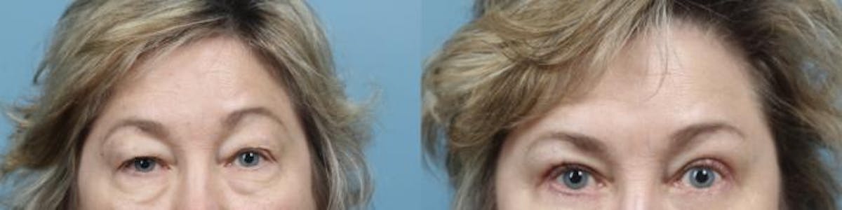 Eyelid Surgery (Blepharoplasty) Before & After Gallery - Patient 411615 - Image 2