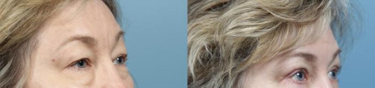 Eyelid Surgery (Blepharoplasty) Before & After Gallery - Patient 411615 - Image 1