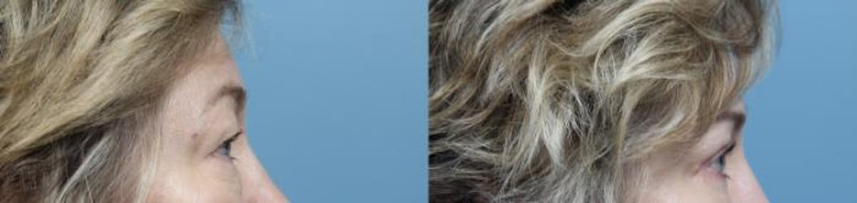 Eyelid Surgery (Blepharoplasty) Before & After Gallery - Patient 411615 - Image 3