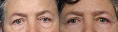 Eyelid Surgery (Blepharoplasty) Before & After Gallery - Patient 419403 - Image 2