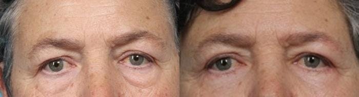 Eyelid Surgery (Blepharoplasty) Before & After Gallery - Patient 419403 - Image 2