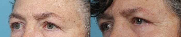 Eyelid Surgery (Blepharoplasty) Before & After Gallery - Patient 419403 - Image 3