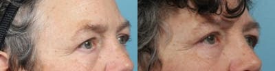 Eyelid Surgery (Blepharoplasty) Before & After Gallery - Patient 419403 - Image 1